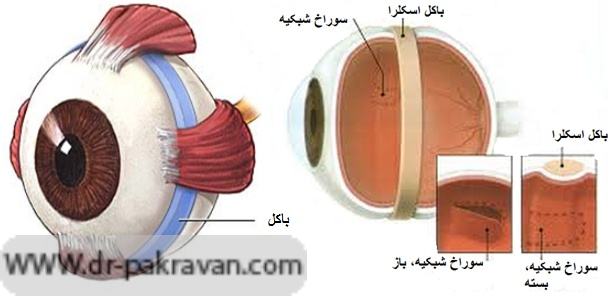 باكل با فشردن ديواره اسكلرا باعث چسباندن مجدد شبکیه به بافت زيرين و بسته شدن سوراخ شبكيه مى‌شود